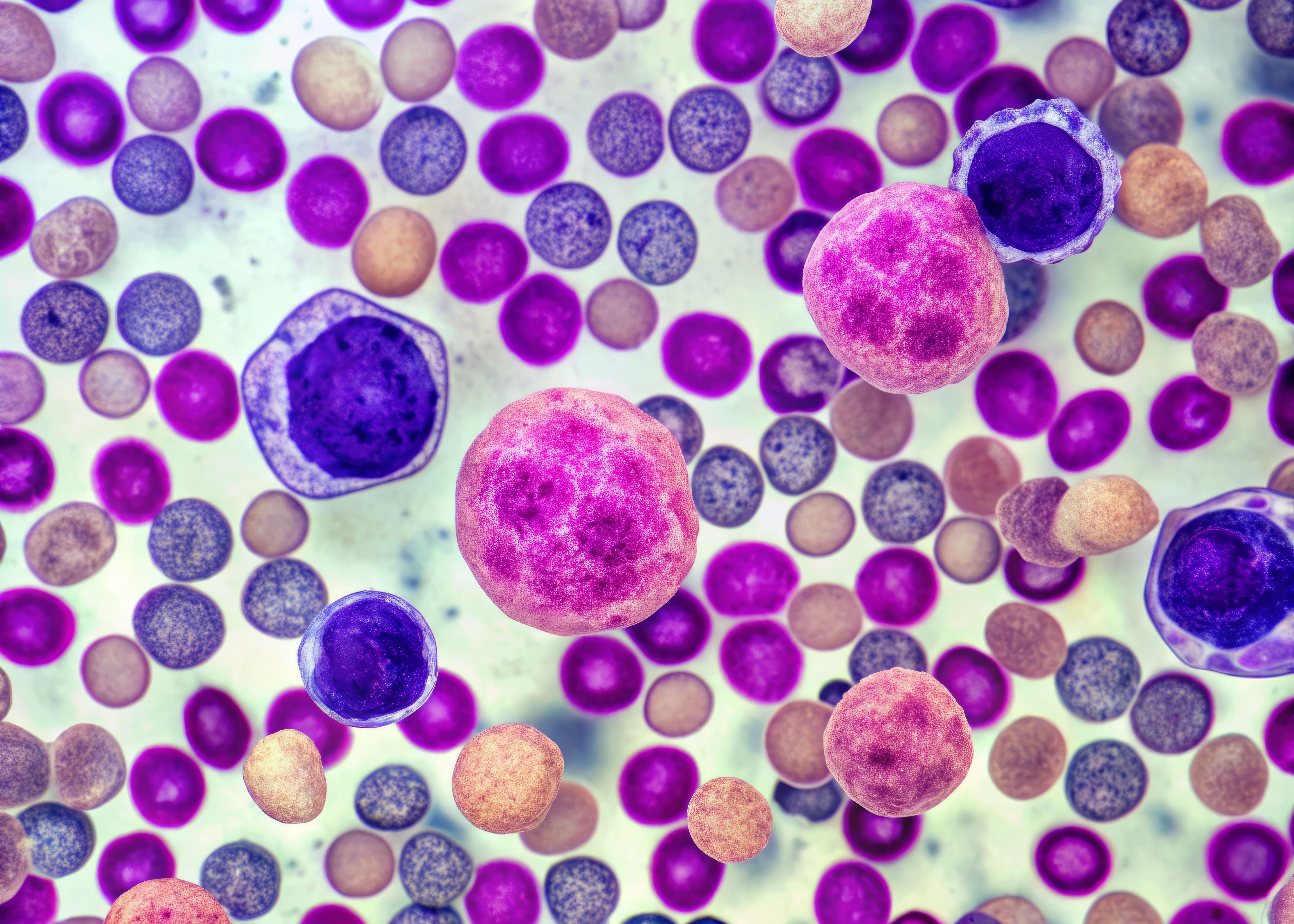 Magnified bone marrow tissue showing multiple myeloma cells | Image Credit: © Curie - stock.adobe.com