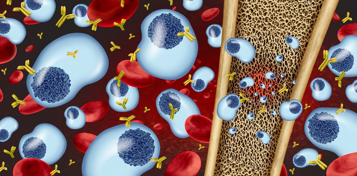 Multiple Myeloma concept and plasma cell cancer as a cancerous growth inside the bone marrow
