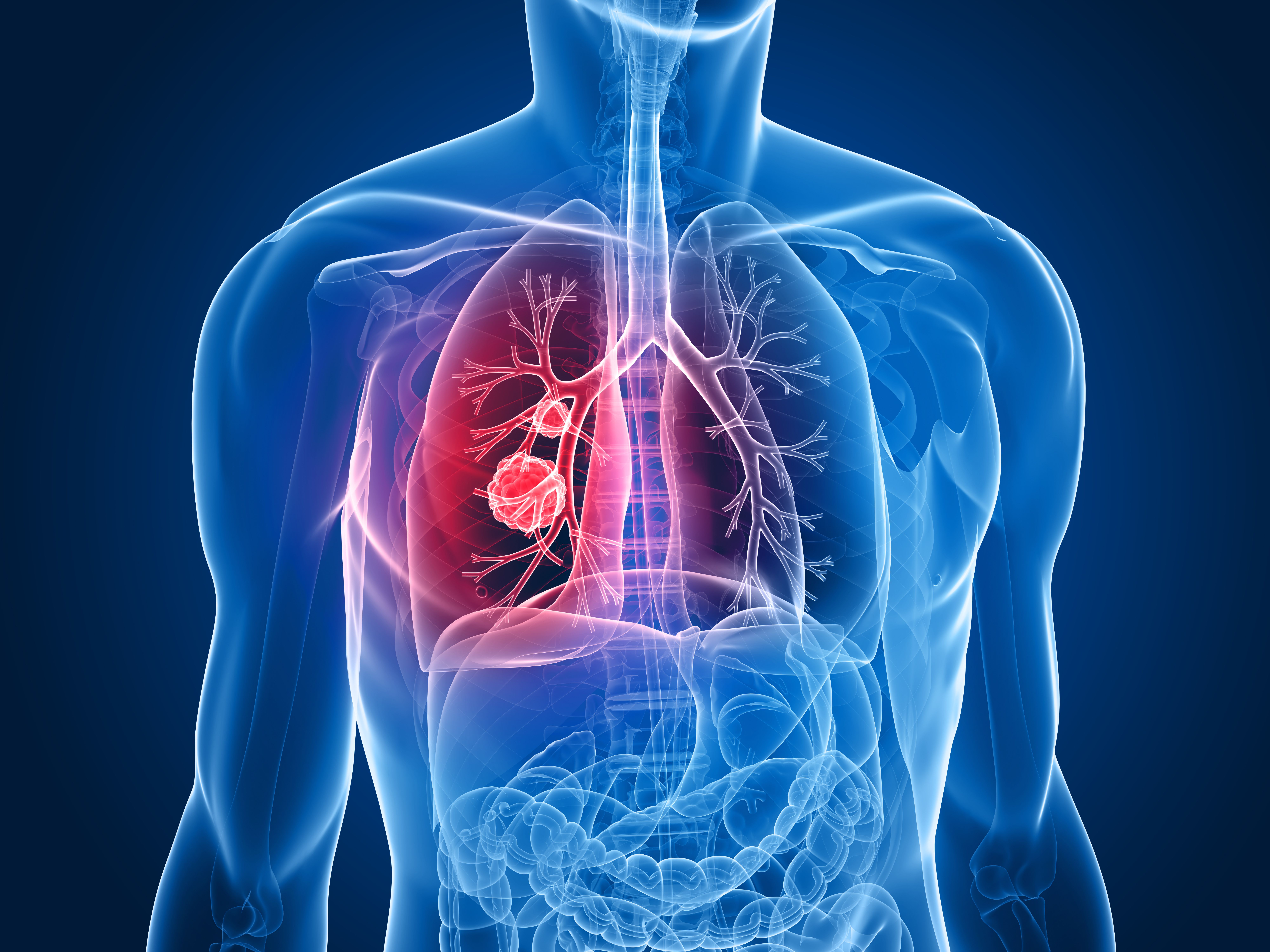 X-ray image of lungs with tumor