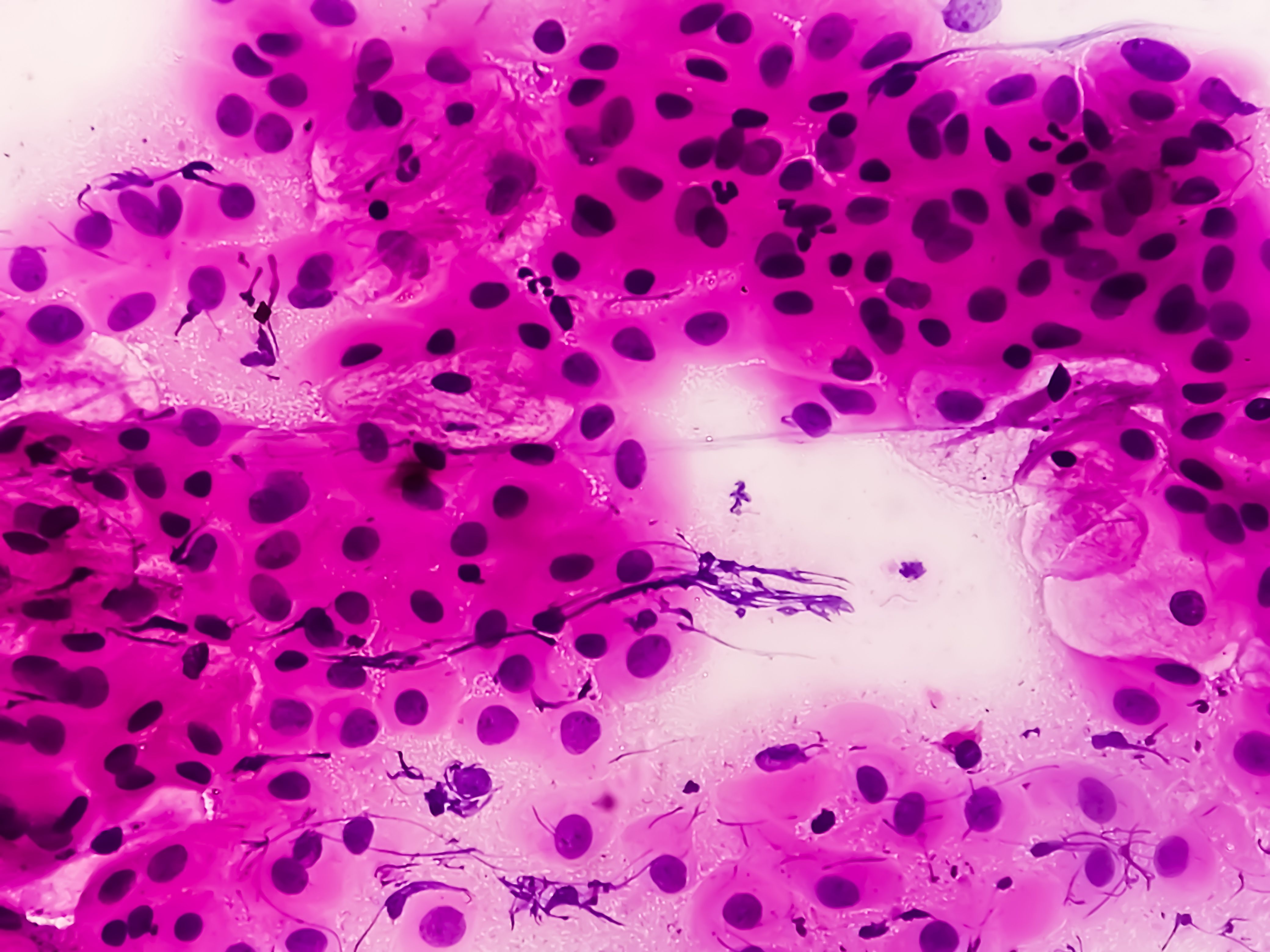 There Is a Need for Better CIN Therapies to Prevent Cervical Cancer