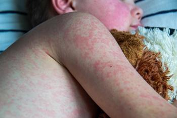 Child with measles-related rash -- Image credit: Luci | stock.adobe.com