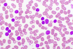 Survival Benefits, Established Safety Profile of Single-agent Ibrutinib for CLL Reinforced in Long-term Phase 3 Study