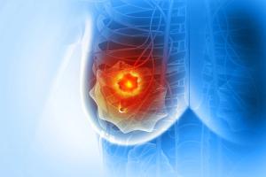 New Study Evaluates Neoadjuvant HER3-Targeted ADC in Early Triple-Negative Breast Cancer