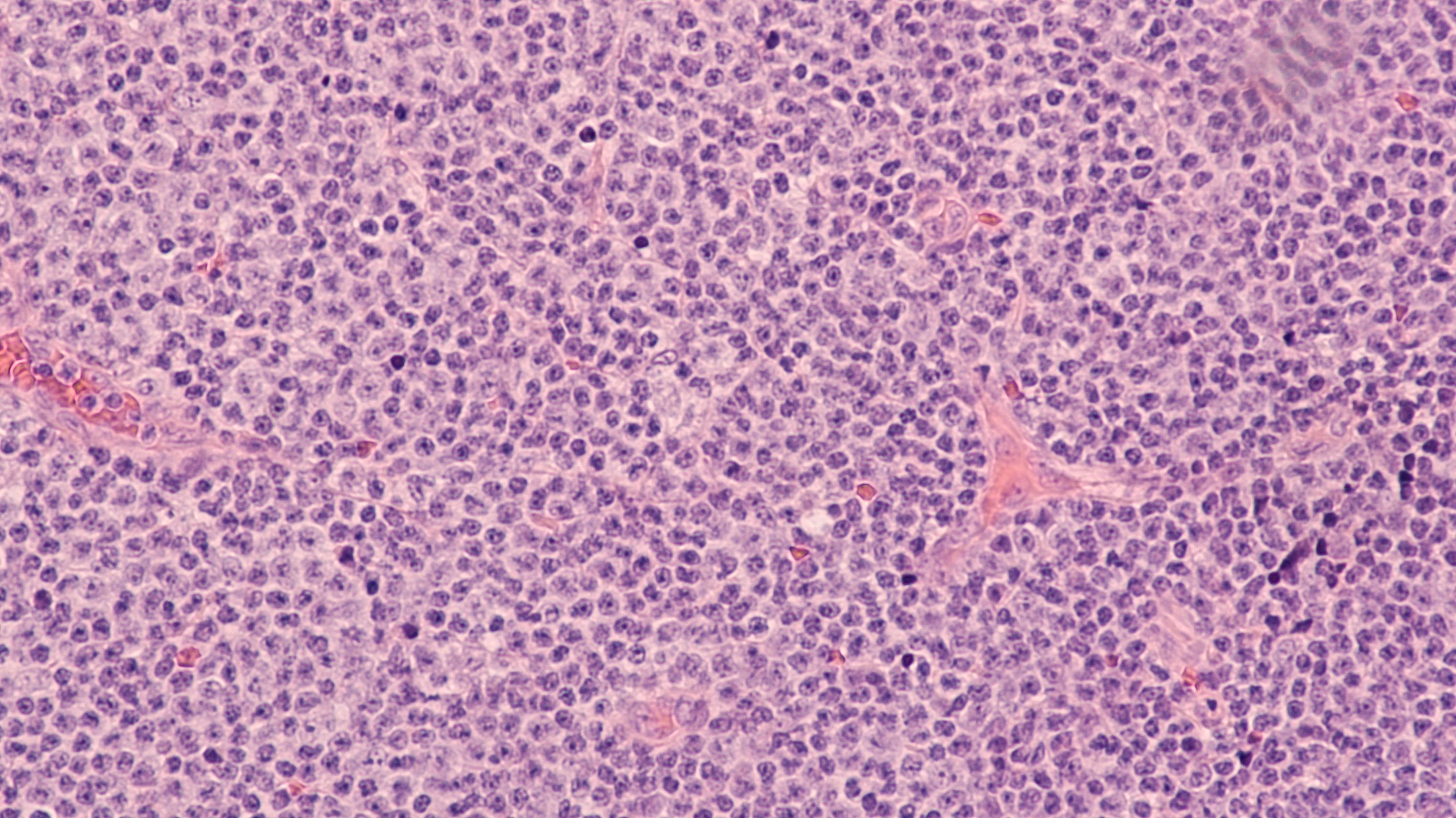 Mantle cell lymphoma -- Image credit: David A Litman | stock.adobe.com