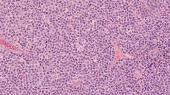 Mantle cell lymphoma -- Image credit: David A Litman | stock.adobe.com