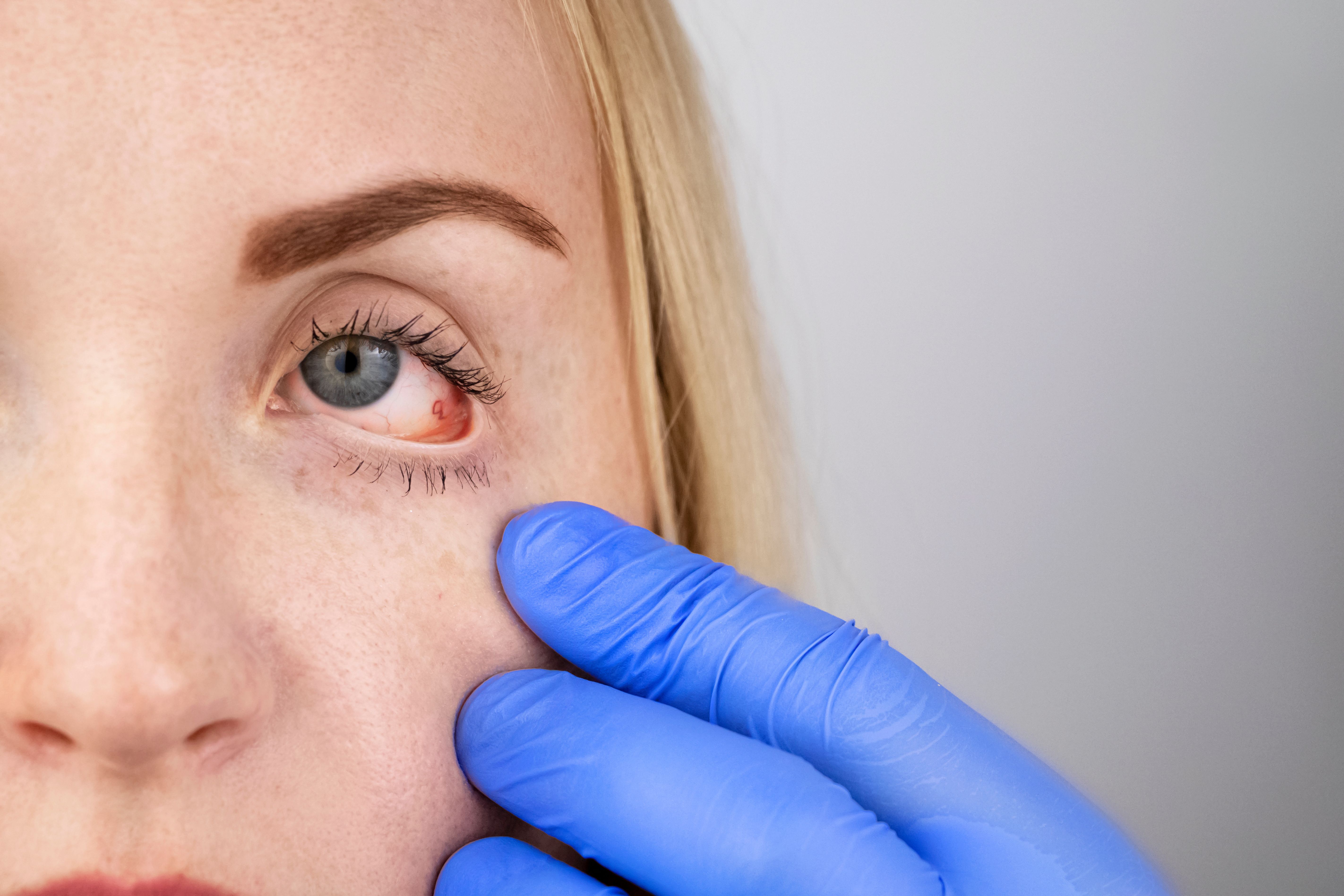 Adalimumab Biosimilar Shows Efficacy in Noninfectious Uveitis