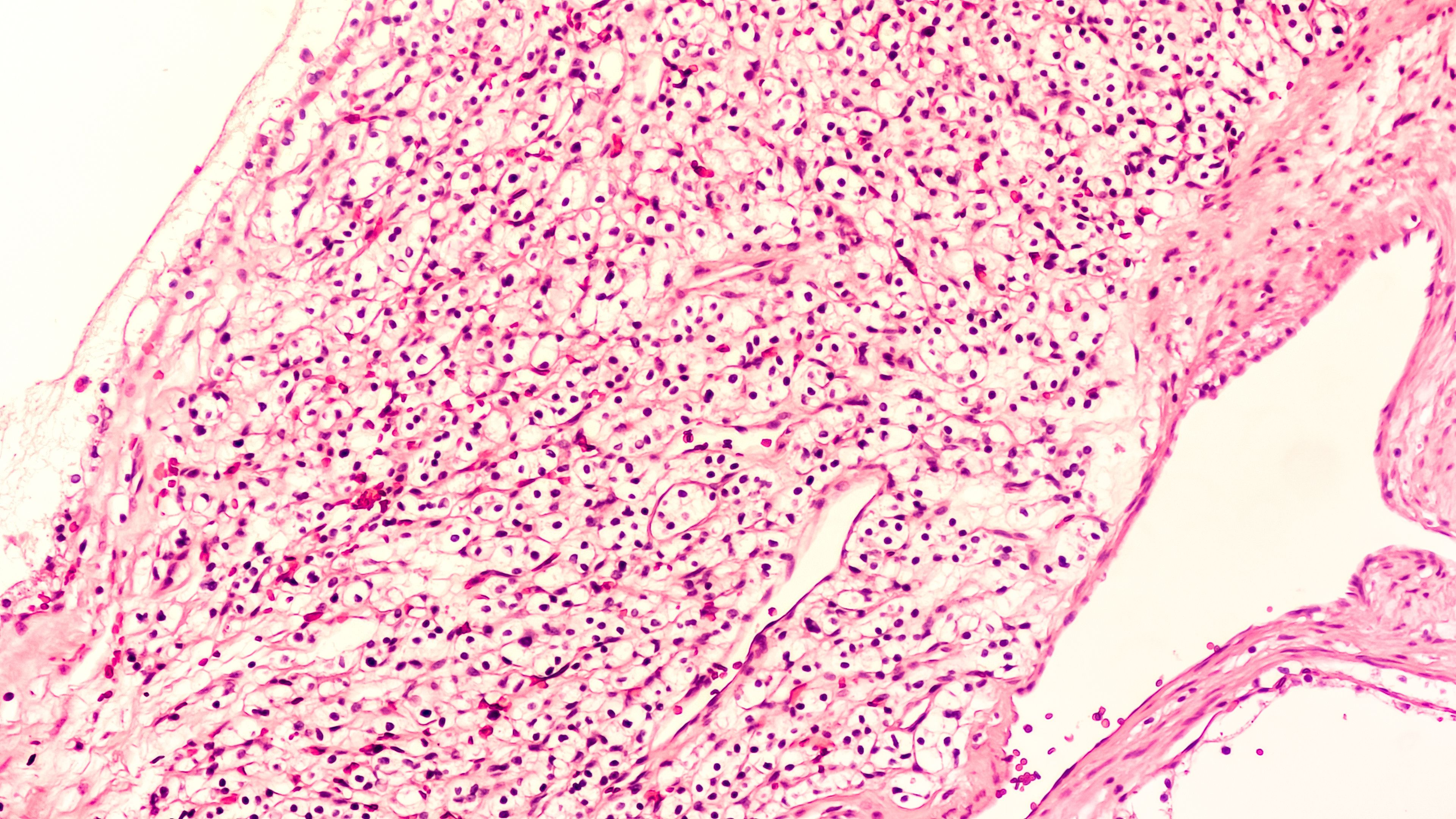 Renal cell carcinoma -- Image credit: David A Litman | stock.adobe.com