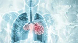 Lung cancer combined with detailed human thoracic anatomy | Image Credit: Ba | stock.adobe.com