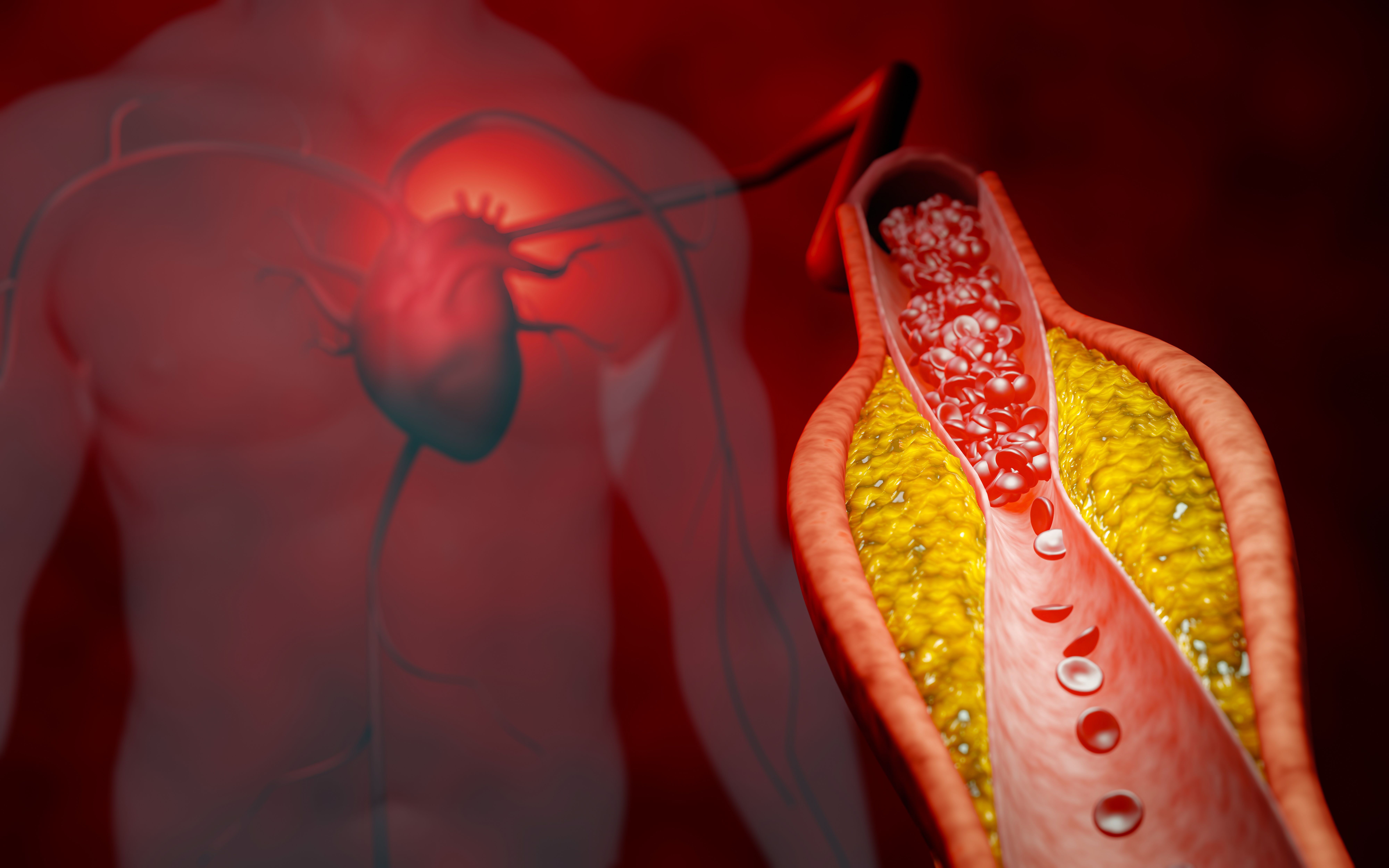 Hyperlipidemia or arteriosclerosis. Blocked artery concept and human blood vessel as a disease with cholesterol fat buildup clogging. Clogged arteries, Cholesterol plaque in the artery. 3D Rendering - Image credit: Superrider | stock.adobe.com
