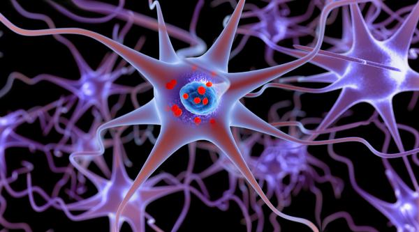 Neurons affected by Parkinson disease -- Image credit: Lars Neumann | stock.adobe.com