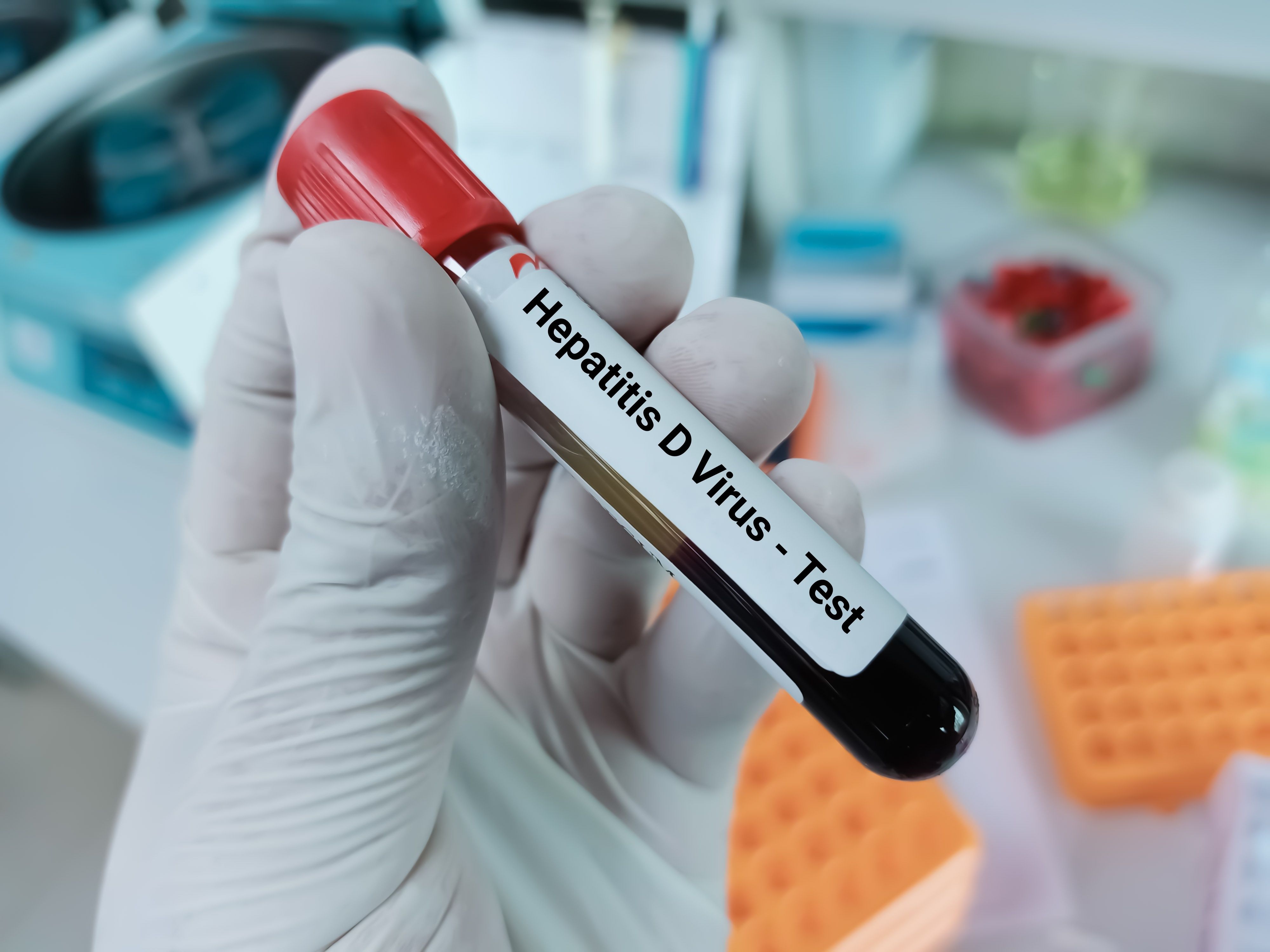 Hepatitis D blood sample | Image Credit: © Innovative Creation - stock.adobe.com