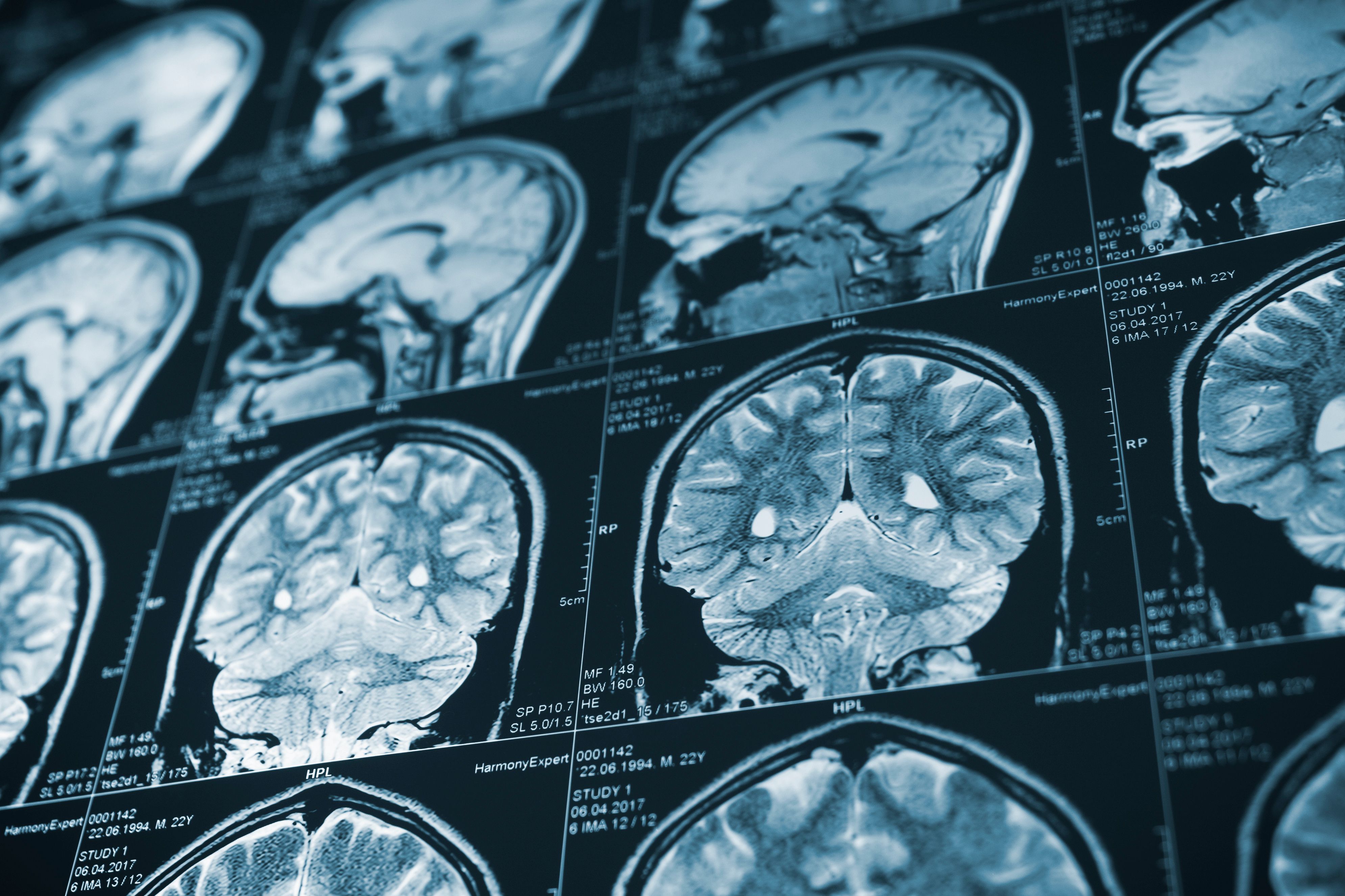 CT scans of brain -- Image credit: Seanid | stock.adobe.com