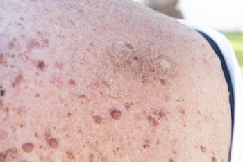 Café-au-lait spots on patient with Neurofibromatosis Type 1 | Image Credit: © Sylvie Pabion Martín - stock.adobe.com