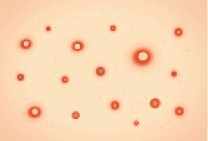 Monkeypox Treatment: Unnecessary Complexity Can Lead to Inequity