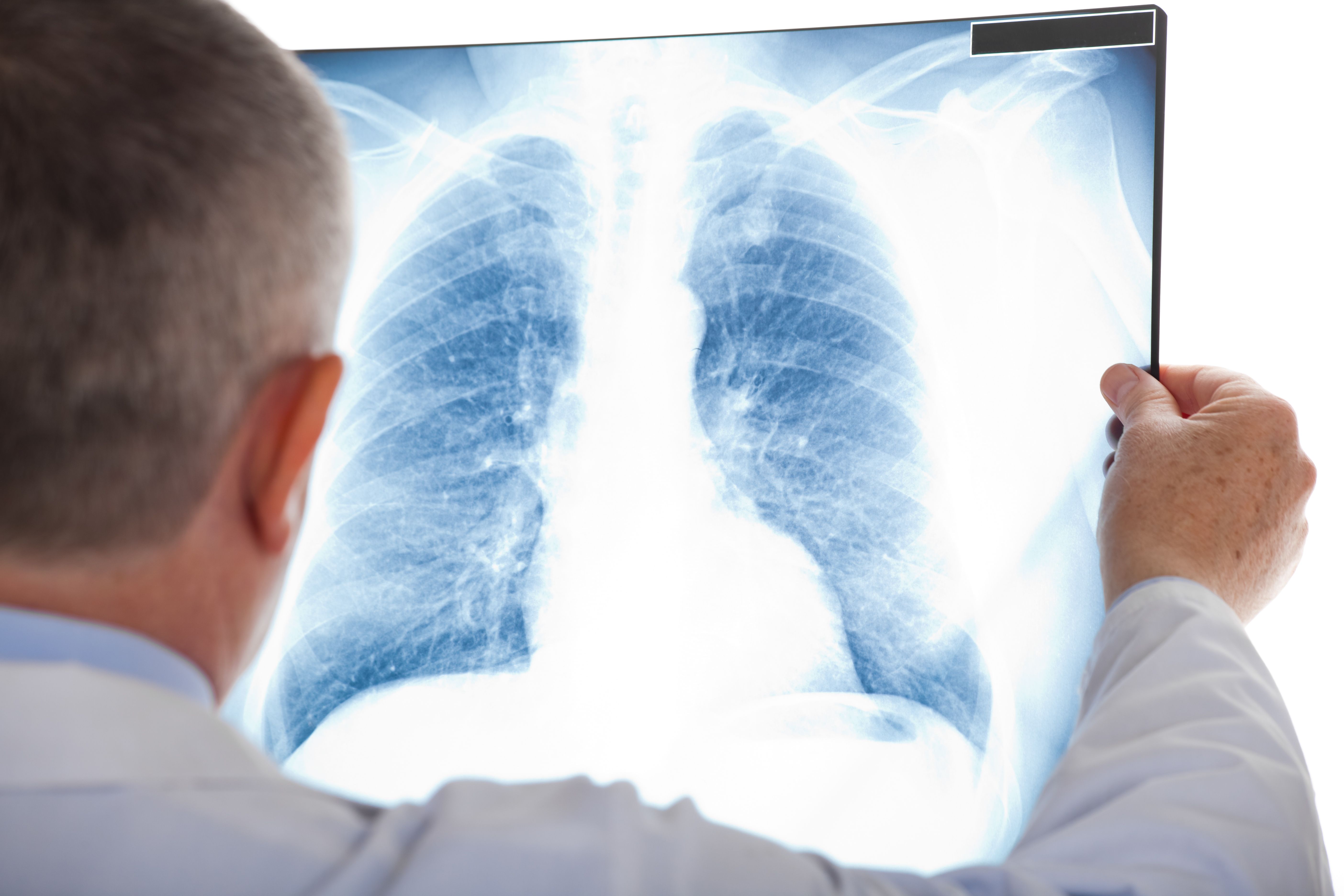 Health care professional looking at x-ray of lungs with NSCLC -- Image credit: Minerva Studio | stock.adobe.com