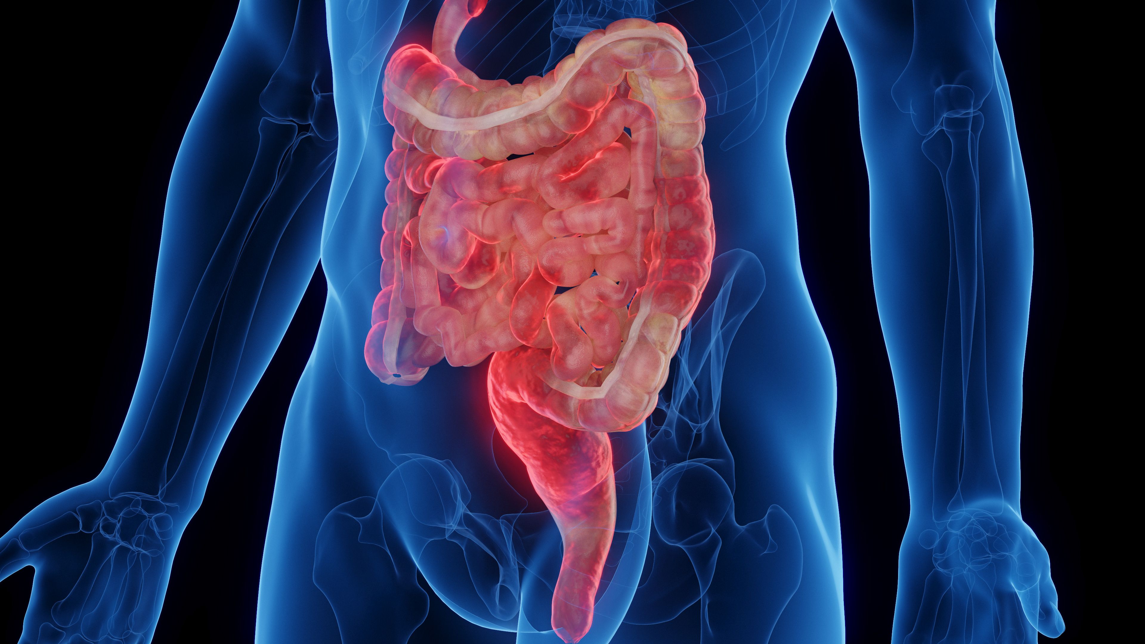 3D medical illustration of a man's intestines affected by Crohn's disease - Image credit: Sebastian Kaulitzki | stock.adobe.com