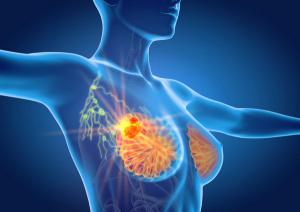 Novel Therapies Show Promise in HER2-Low Metastatic Breast Cancer
