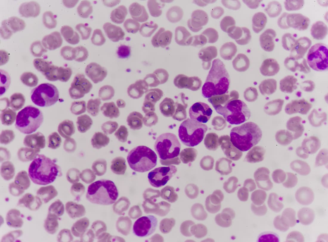 Leukemia blood cells medical science background concept.