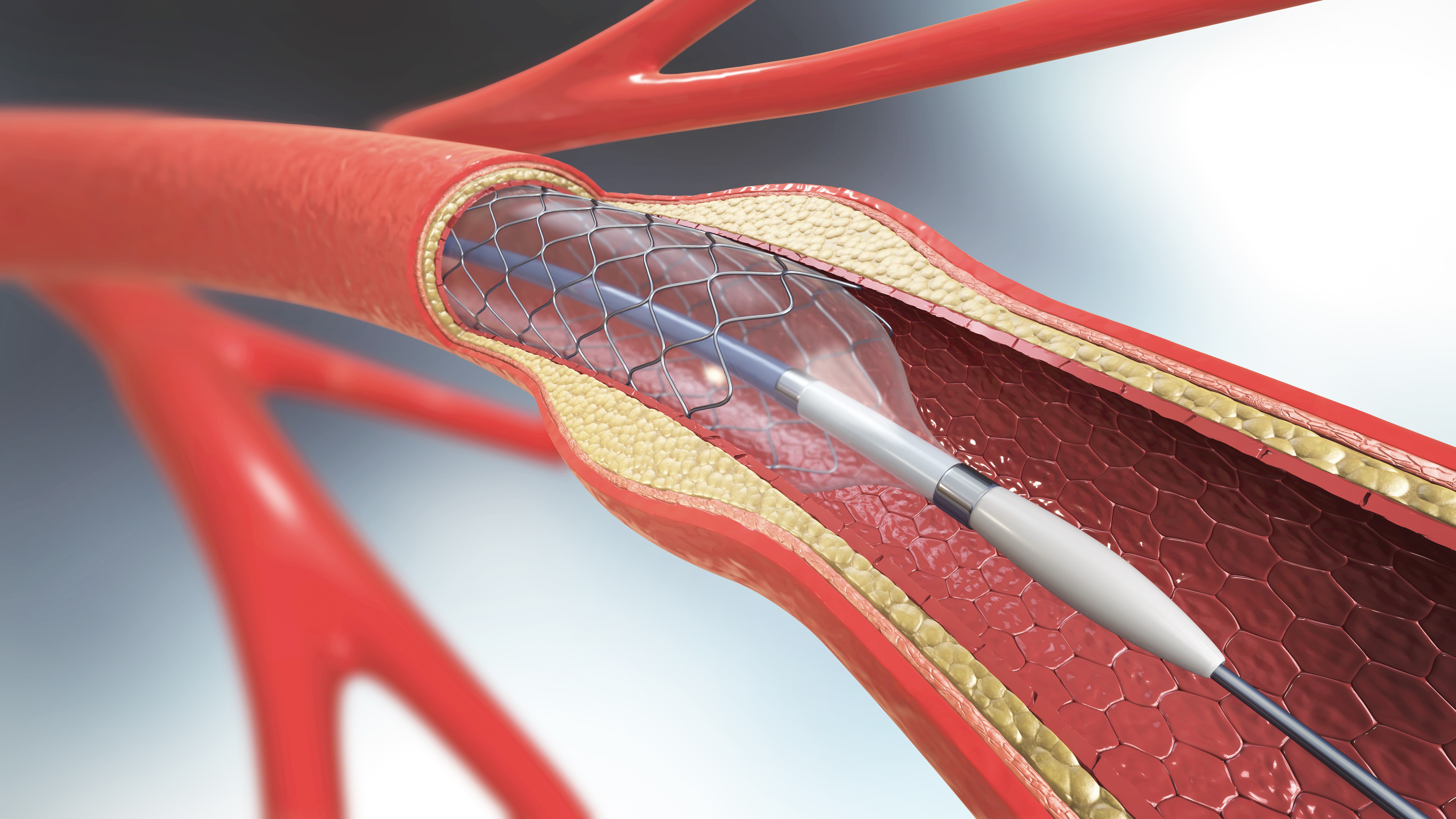 <![CDATA[Achieving Optimal LDL-C Helps Prevent Neoatherosclerosis, Late Stent Failure in Patients With STEMI]]>