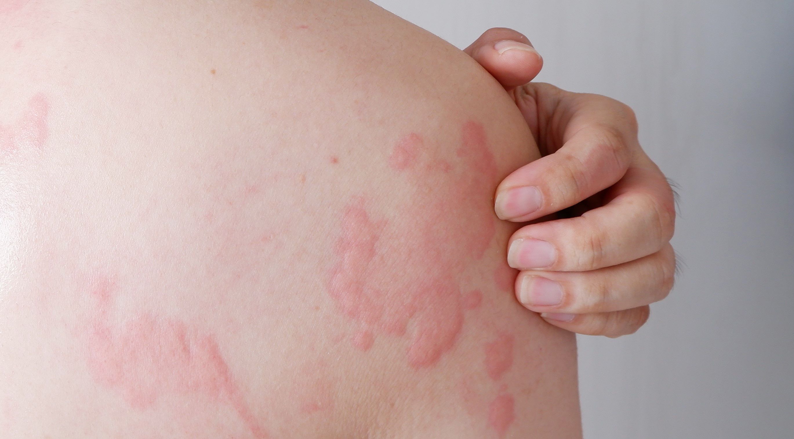 Person with allergic hives on their skin -- Image credit: wisely | stock.adobe.com