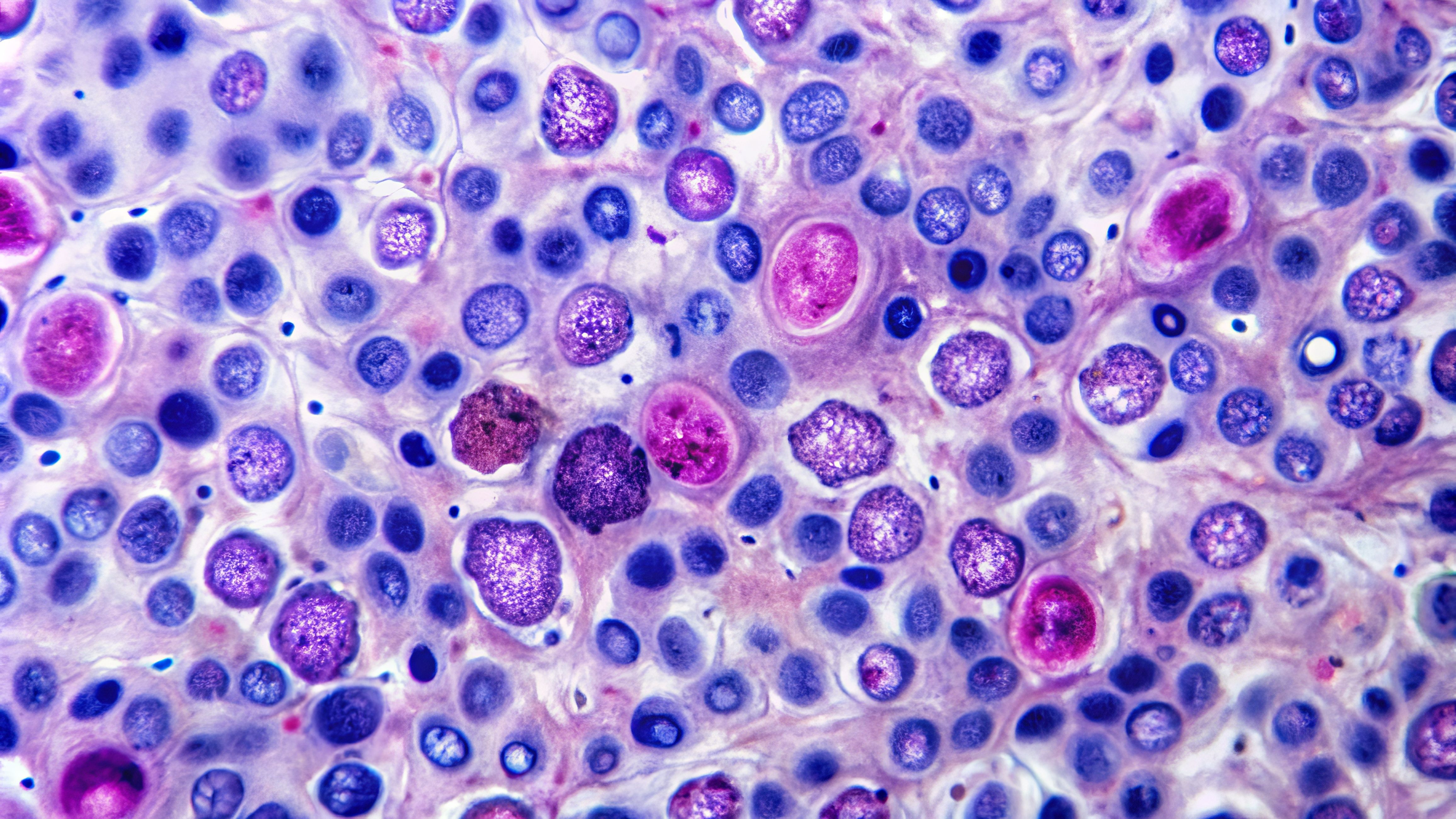 Non-Hodgkin lymphoma -- Image credit: Man888 | stock.adobe.com