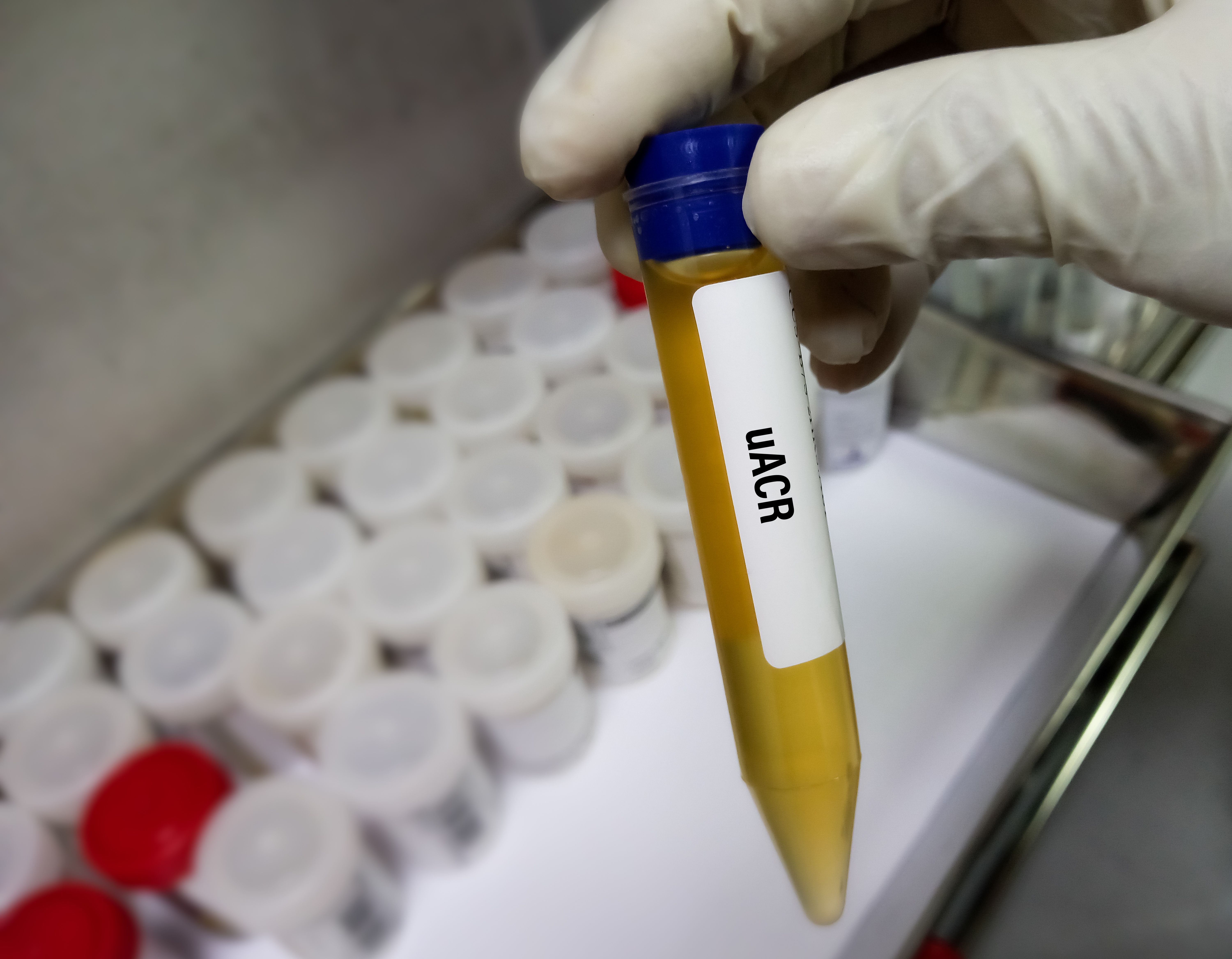 UACR test for chronic kidney disease (CKD) -- Image credit: MdBabul | stock.adobe.com