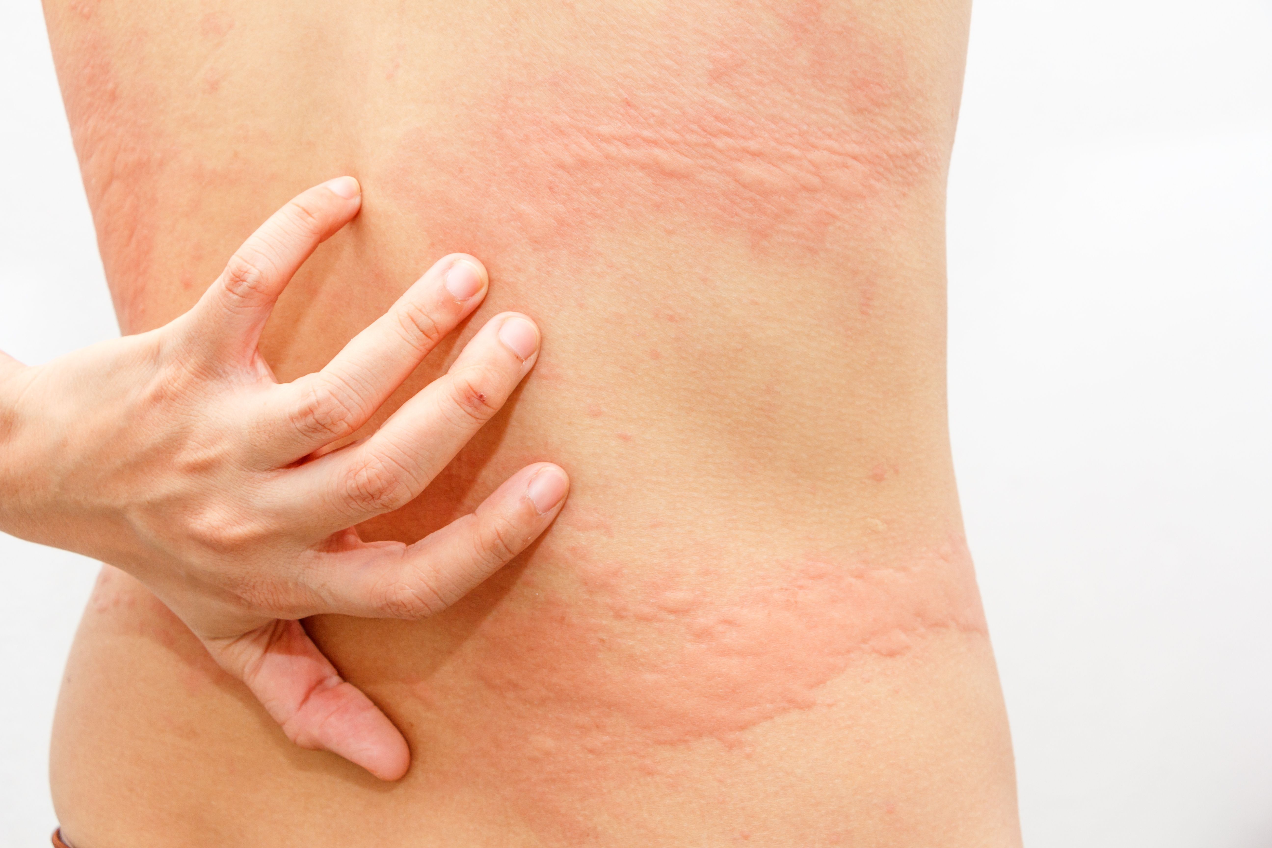 Women with symptoms of itchy urticaria.- Image credit: Kanachaifoto | stock.adobe.com