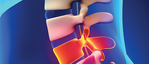 Placebo Treatment Effective for Chronic Back Pain