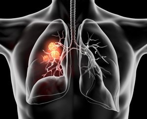 FDA Expands Indication of Lorlatinib for ALK-Positive Non–Small Cell Lung Cancer