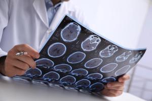 Health care professional looking at MRI scans of brain affected by multiple sclerosis (MS) -- Image credit: New Africa | stock.adobe.com