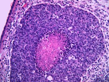 Detail of high grade urothelial carcinoma of the ureter in a man. The tumor has central necrosis which appears pink. Microscopic view. | Image Credit: Lisa | stock.adobe.com