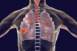 Sugemalimab Demonstrates Overall Survival Benefit in Stage IV Non-Small Cell Lung Cancer