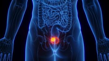 3D medical illustration of bladder cancer | Image Credit: © Sebastian Kaulitzki - stock.adobe.com