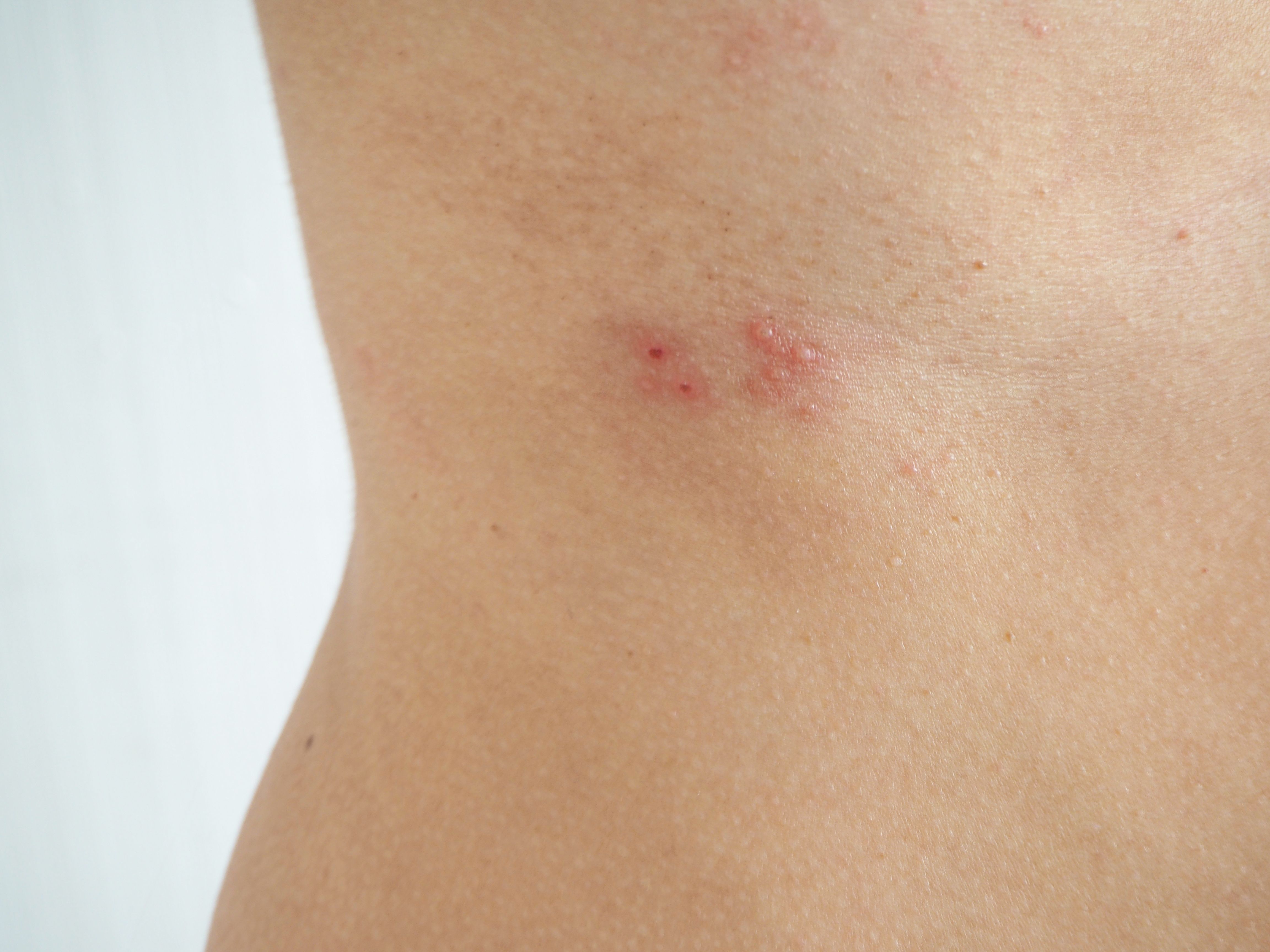 herpes zoster or shingles in woman on her waist , cause of varicella zoster virus infections symptoms of itchy ,rash and raised dots on skin and redness with pain and tingling suffering - Image credit: jaojormami | stock.adobe.com