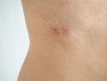 herpes zoster or shingles in woman on her waist , cause of varicella zoster virus infections symptoms of itchy ,rash and raised dots on skin and redness with pain and tingling suffering - Image credit: jaojormami | stock.adobe.com 