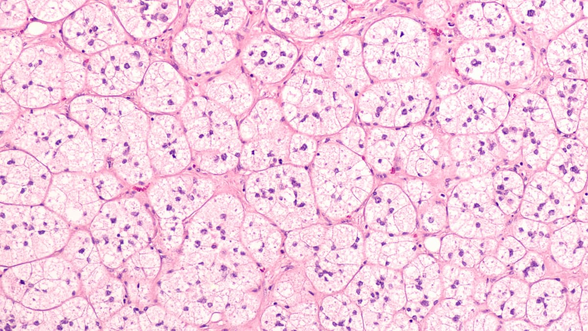 Microscopic image of an adrenal cortical adenoma, a benign tumor of the adrenal gland, which may produce hormones cortisol or aldosterone and lead to Cushing's syndrome or primary hyperaldosteronism.