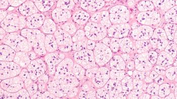 Microscopic image of an adrenal cortical adenoma, a benign tumor of the adrenal gland, which may produce hormones cortisol or aldosterone and lead to Cushing's syndrome or primary hyperaldosteronism.