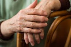 Trials Shows Efficacy of Otilimab in Moderate to Severe Rheumatoid Arthritis Not Statistically Significant