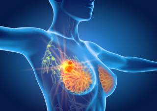 Pharmacist Medication Insights: Margetuximab for Metastatic HER2-Positive Breast Cancer