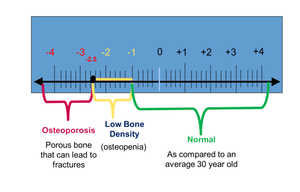 Pharmacy Clinical Pearl Of The Day Bone Density And T Score