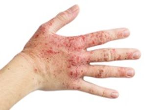 New Eczema Treatment Shows Superior Efficacy