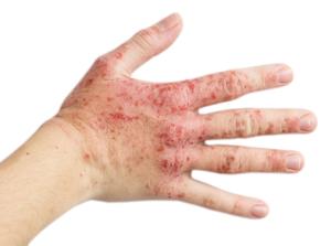 Majority Treated with Lebrikizumab Show Skin Clearance in Lilly's Atopic Dermatitis Studies