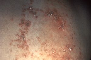 ACIP Recommends Herpes Zoster Subunit Vaccine