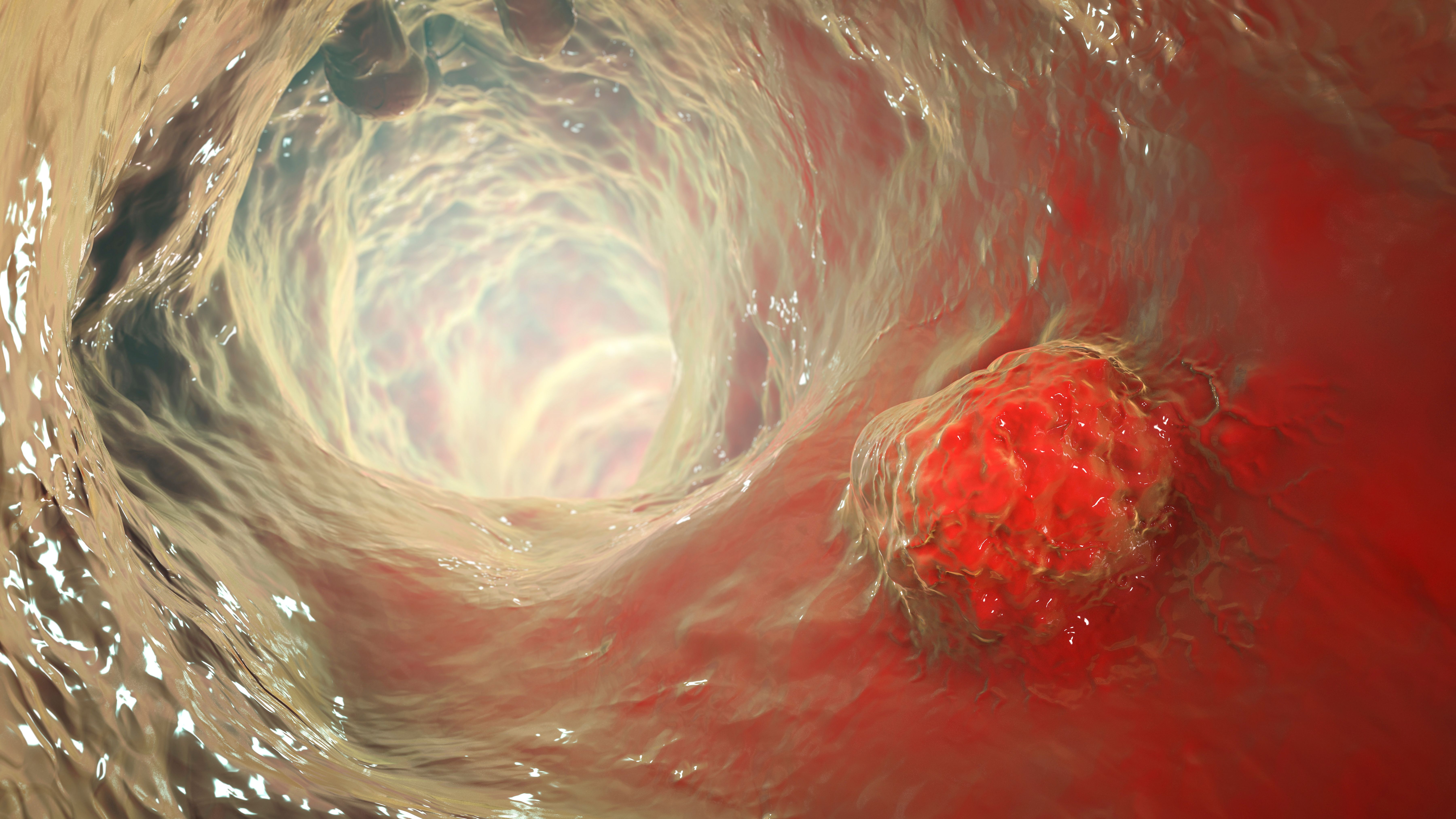 Depiction of colorectal cancer tumor growth Image Credit: © Dr_Microbe - stock.adobe.com