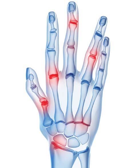 2. fokozatú rheumatoid arthritis)