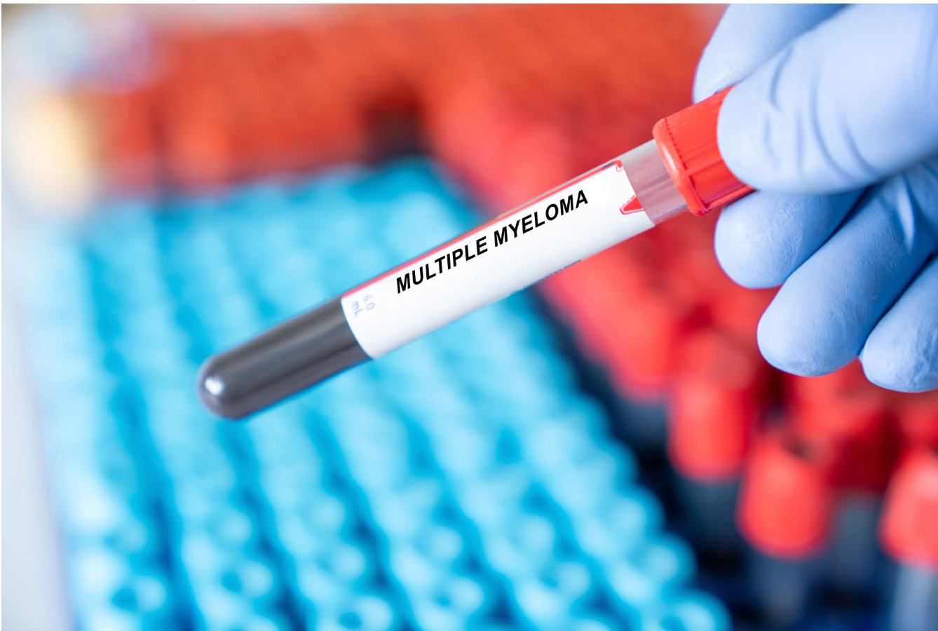 Financial Burden May Be the Largest Barrier to CAR T-Cell Therapy for the Treatment of Multiple Myeloma - Vimarsana News