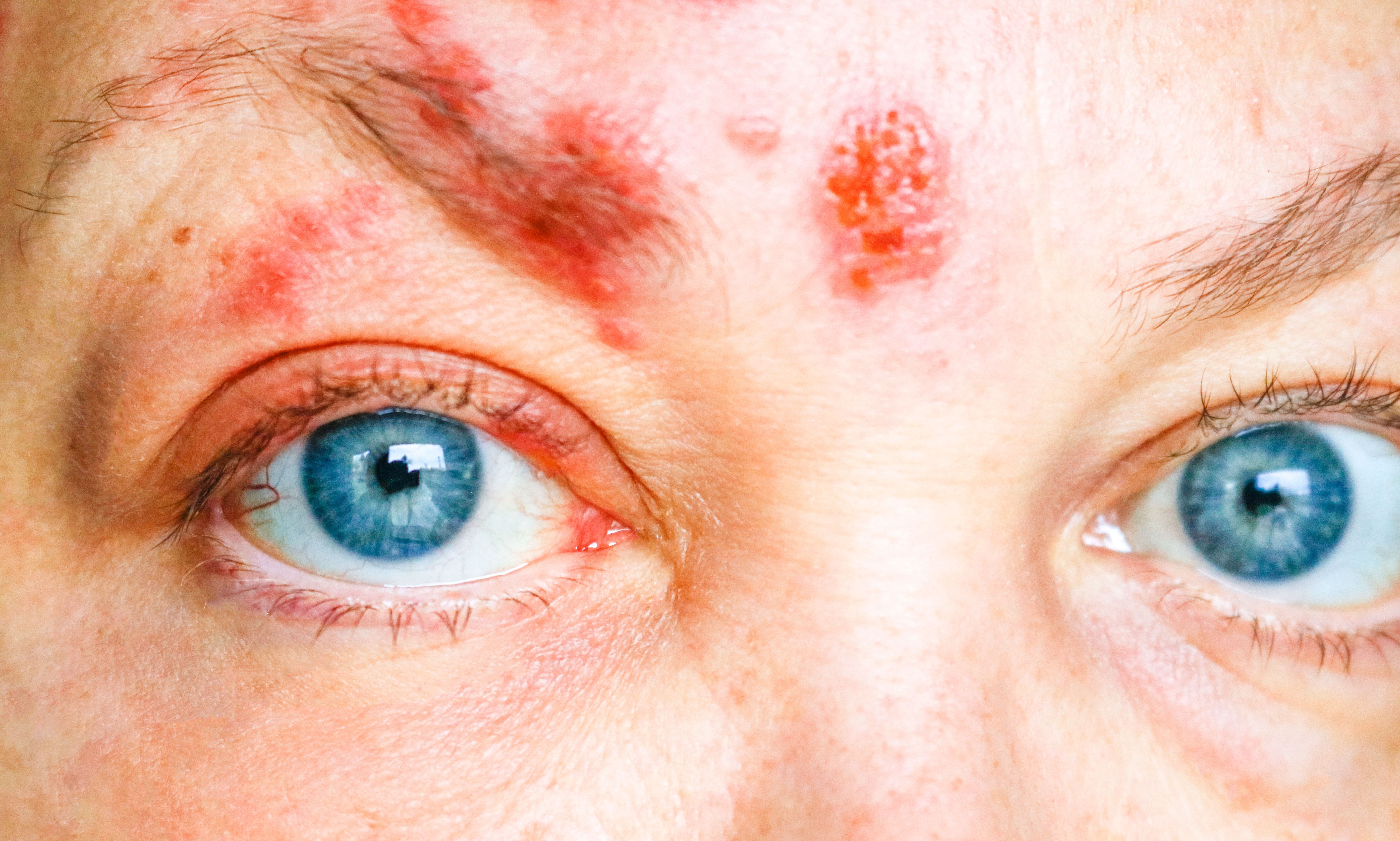 Shingles on the Face and Around the Eye, Called ophthalmic herpes zoster or varicella-zoster virus infection - Image credit: lganz | stock.adobe.com