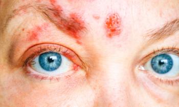 Shingles on the Face and Around the Eye, Called ophthalmic herpes zoster or varicella-zoster virus infection - Image credit: lganz | stock.adobe.com 