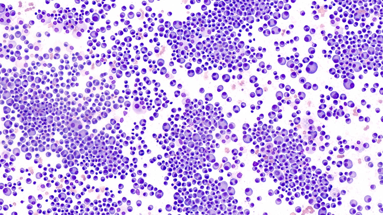 Multiple Myeloma Awareness: Bone marrow aspirate cytology of multiple myeloma, a type of bone marrow cancer of malignant plasma cells, associated with bone pain, bone fractures and anemia