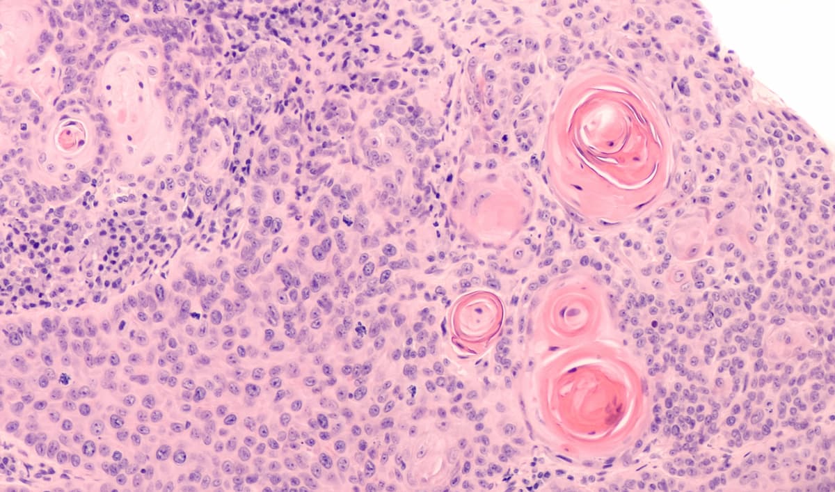 Photomicrograph of a CT (CAT) scan-guided needle core biopsy showing pulmonary squamous cell carcinoma, a type of non-small cell carcinoma usually associated with smoking